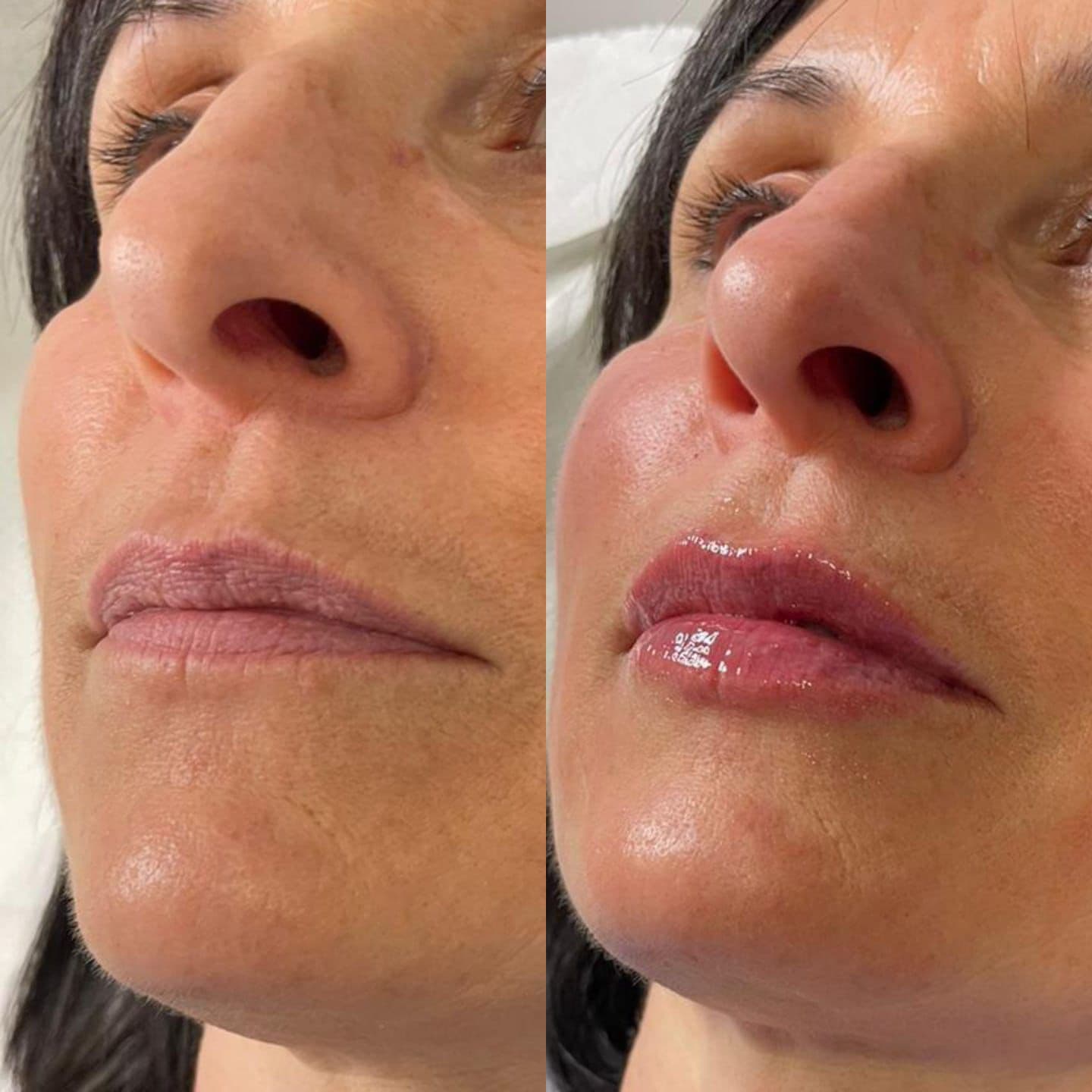 Resultado antes y después de relleno de labios con ácido hialurónico — Clínica Pura Vida Valencia