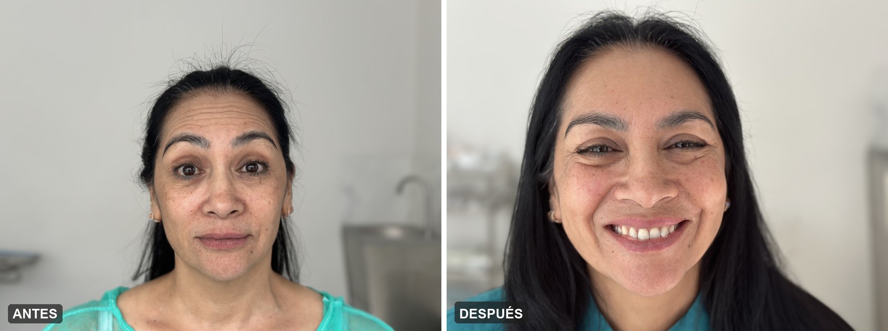 Antes y después de tratamiento con neuromoduladores (botox) — Clínica Pura Vida Valencia